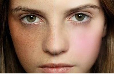 專業(yè)修復(fù)雙眼皮評(píng)論解析，醫(yī)生點(diǎn)評(píng)&網(wǎng)友手術(shù)對(duì)比曝光，必看照片分享