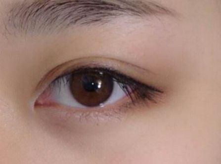 杭州任東做鼻部整容效果如何？MD技術解析真實案例分享！