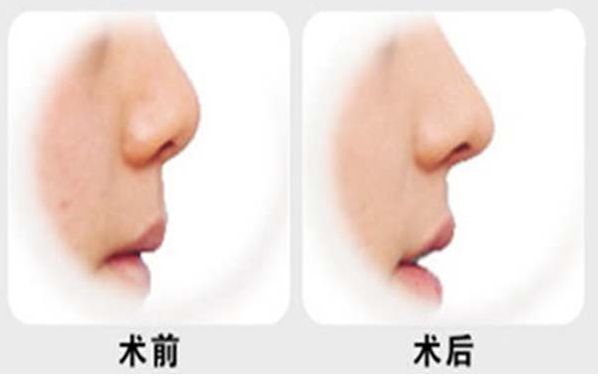 燕雄鼻子整容結(jié)果亮相！專家實(shí)力和成功案例揭秘