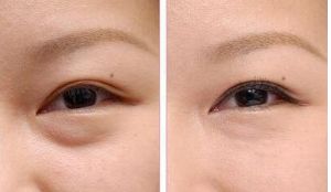 李鴻軍醫(yī)生點(diǎn)評(píng)：上海患者的鼻子整形經(jīng)驗(yàn)分享