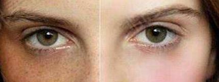 蘇薇潔與楊亞益對比，誰能讓你的雙眼皮完美？實力專家比拼！