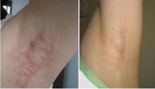 南京哪家醫(yī)院能夠完美實(shí)現(xiàn)雙眼皮手術(shù)的期望？