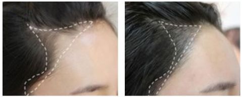 西安丁合軍的鼻子修復(fù)效果如何？90天真實(shí)案例分享