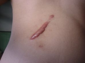 滄州靜港醫(yī)院雙眼皮手術(shù)效果如何？哪位醫(yī)生值得信賴？手術(shù)費(fèi)用參考表同步分享