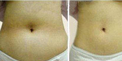 深圳李曉平醫(yī)生鼻部整形：實力醫(yī)生的案例展示