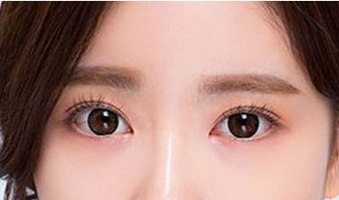 鄭州葛艷娜雙眼皮整形技術(shù)及真實(shí)案例分享