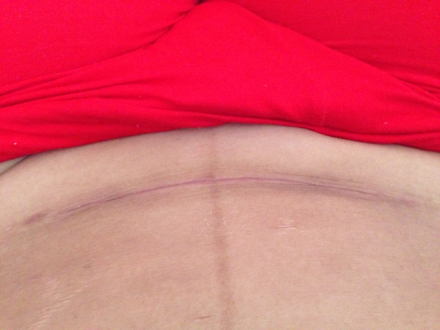 如何避免自體脂肪注射豐胸的風(fēng)險(xiǎn)？務(wù)必掌握這些關(guān)鍵信息