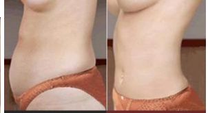 美容整形的切口位置如何選擇？