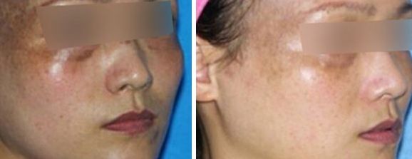 南寧?kù)诿泪t(yī)療美容門(mén)診部黃新醫(yī)生，隆胸案例詳解，完美服務(wù)細(xì)致入微