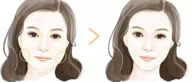 北京黎星醫(yī)生的面部脂肪填充效果如何？真實案例揭秘！