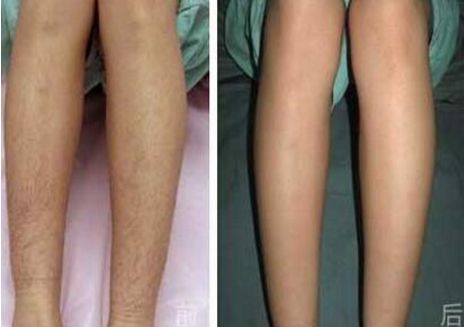 溫州自體脂肪隆鼻哪家醫(yī)院靠譜？熱門(mén)醫(yī)院推薦排行榜揭曉！