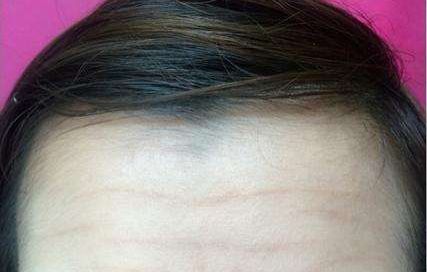 陳金超醫(yī)生高效雙眼皮效果秀！超卓案例展示揭示驚喜效果！