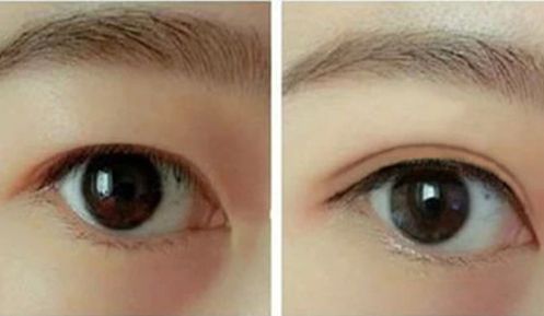 李世榮隆鼻的效果如何？西南醫(yī)院醫(yī)生經(jīng)典案例揭秘