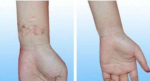 柴云醫(yī)生做雙眼皮后亮麗綻放！欣賞真實案例，驚艷非凡的視覺效果！