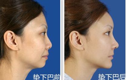 上海九院鼻部整形手術(shù)專家李圣利，專業(yè)水準(zhǔn)如何？