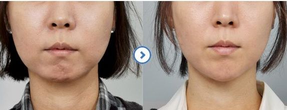 合肥近視矯正專家排行榜比較瑞亞與華美最佳眼部整形醫(yī)院