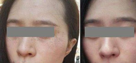 福建省立醫(yī)院楊宇醫(yī)生的隆鼻案例分享