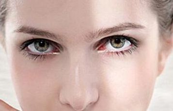 成都軍建醫(yī)院的雙眼皮修復(fù)效果太驚人！手術(shù)痕跡隱藏完美，效果自然持久！