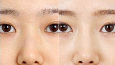 專業(yè)排行榜出爐！北京最頂級雙眼皮醫(yī)生名單公布！