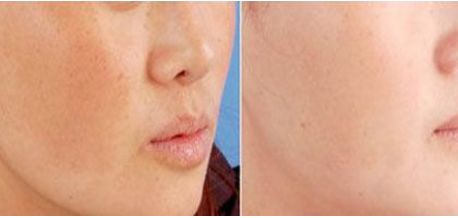 朱海男全切雙眼皮手術(shù)費(fèi)用及醫(yī)生簡介、價(jià)格表解析！