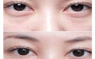 北京張笑天的下頜角手術技術及豐碩成果曝光！醫(yī)術精湛，案例展示震撼人心