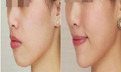 北京乳房整形首選之醫(yī)院：北京大學第三醫(yī)院值得推薦！