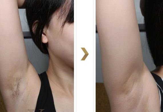 長沙湘雅醫(yī)院的減肥科如何？大腿吸脂效果如何？