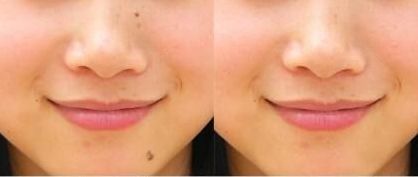 上海九院李茅醫(yī)生的雙眼皮手術(shù)效果如何？90天見證分享給你！