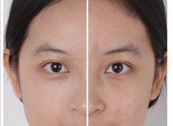 上海華美整形醫(yī)院展示用面部脂肪填充為您帶來(lái)全新視角