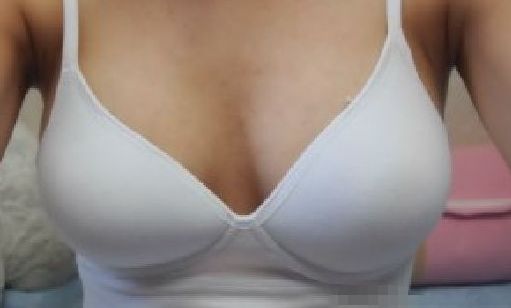 天后朱東磊鼻子整形效果如何？專(zhuān)家評(píng)估結(jié)果公開(kāi)解析