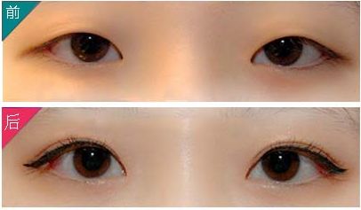 九院朱海男雙眼皮手術(shù)效果與價(jià)格一覽，了解最新資訊！