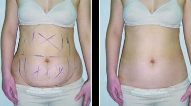 鄭州沐整形醫(yī)院：親測(cè)雙眼皮效果分享