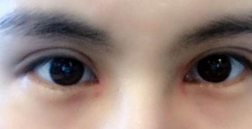 劉林奇：西南醫(yī)院墊下巴手術效果曝光！手術費用一覽表附近