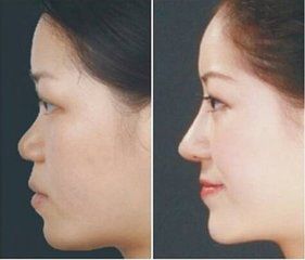 成都邱偉醫(yī)生雙眼皮術(shù)的成功案例分享