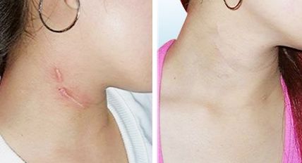 蘭州亞韓雙眼皮整形費(fèi)用一覽，談?wù)勈中g(shù)技巧與費(fèi)用