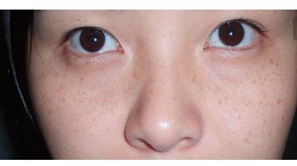 張恒術(shù)雙眼皮手術(shù)80天后效果揭曉，驚喜呈現(xiàn)！