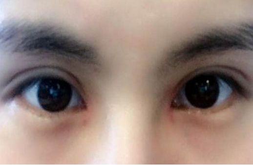 專家執(zhí)針絕活，您知道哪位醫(yī)生在注射物取出方面最厲害嗎？獨特手法排行榜前五名大揭曉