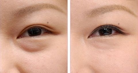 成都李烈療法注脂面部效果令人驚嘆！實例揭秘