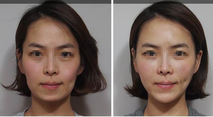 深圳頂級乳房整形專家團(tuán)隊？權(quán)威醫(yī)院解答哪家三甲醫(yī)院最適合隆胸