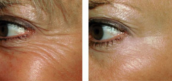 綿陽(yáng)哪家醫(yī)院做雙眼皮效果好？暗藏細(xì)節(jié)，嫵媚妥妥！