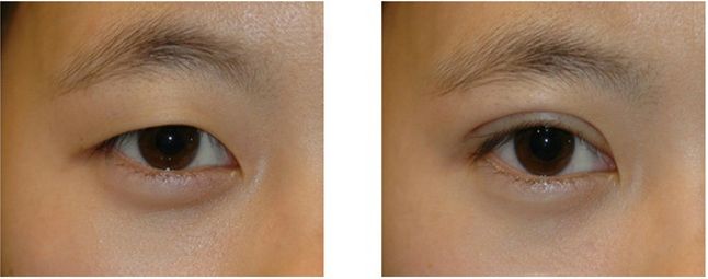 四川省人民醫(yī)院盛陽(yáng)醫(yī)生綜合評(píng)價(jià)及吸脂手術(shù)詳解！