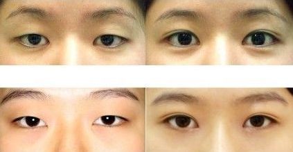 成都雙眼皮修復(fù)醫(yī)生最新名單出爐！頂尖專家蔡玲、王強等領(lǐng)銜榜單