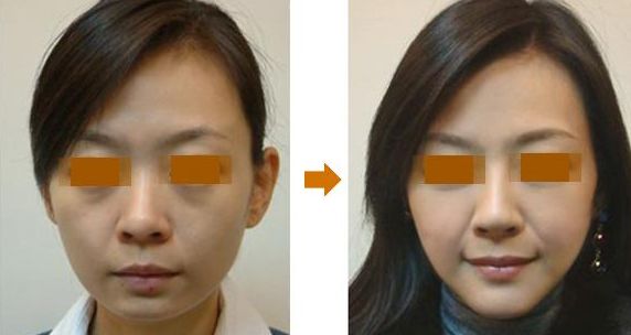 國內(nèi)口碑推薦的下頜角手術(shù)醫(yī)院，上海和武漢地區(qū)有哪些知名醫(yī)院？