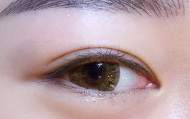 鄒翀，這一雙眼皮技術(shù)，近期有所革新