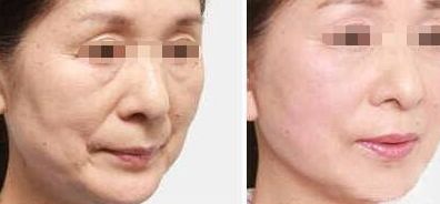 寧波頂級(jí)醫(yī)院去眼袋的價(jià)格及經(jīng)驗(yàn)分享