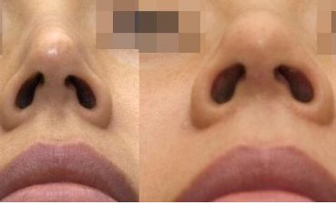 南寧整形醫(yī)院治療疤痕效果如何？最佳選擇揭秘