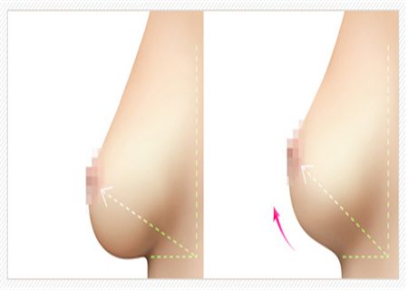 哈爾濱醫(yī)大一院乳房隆胸技藝揭秘！最新案例驚艷發(fā)布