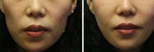 洛陽市第三人民醫(yī)院整形科雙眼皮效果如何？2023真實(shí)案例分享