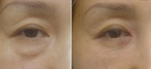 北京八大處趙延勇醫(yī)生的雙眼皮手術(shù)如何？了解醫(yī)院背景和手術(shù)案例。