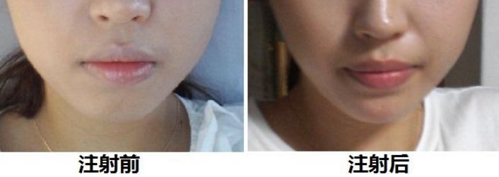 廣州豐胸手術(shù)那家靠譜？最新推薦！整形技術(shù)、價格醫(yī)生保駕護航